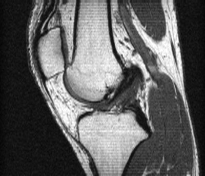 MRI slice of the knee