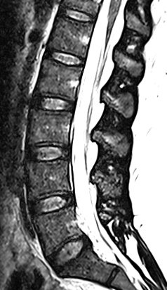 T2 MRI of the lumbar spine