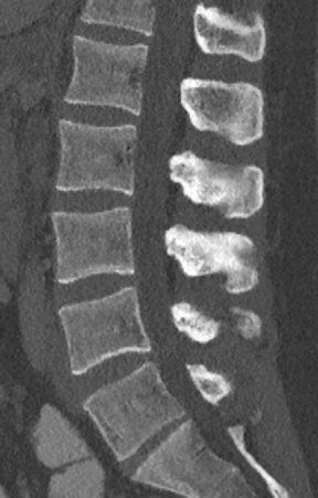 Sagittal CT slice of the lumbar spine