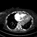 CT slice of the thorax